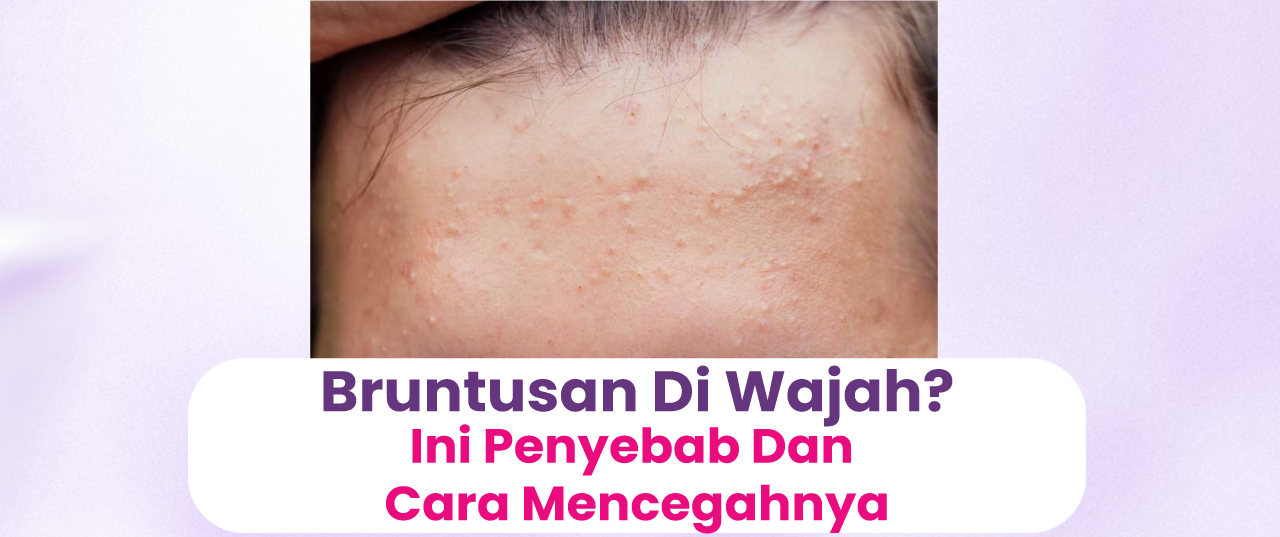 Bruntusan di Wajah? Ini Penyebab dan Cara Mencegahnya